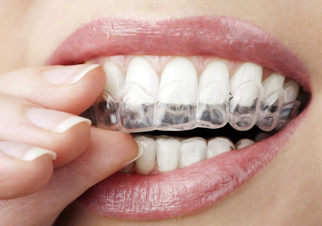 Nahaufnahme eines weiblichen Mundes mit Invisalign an den Zähnen.